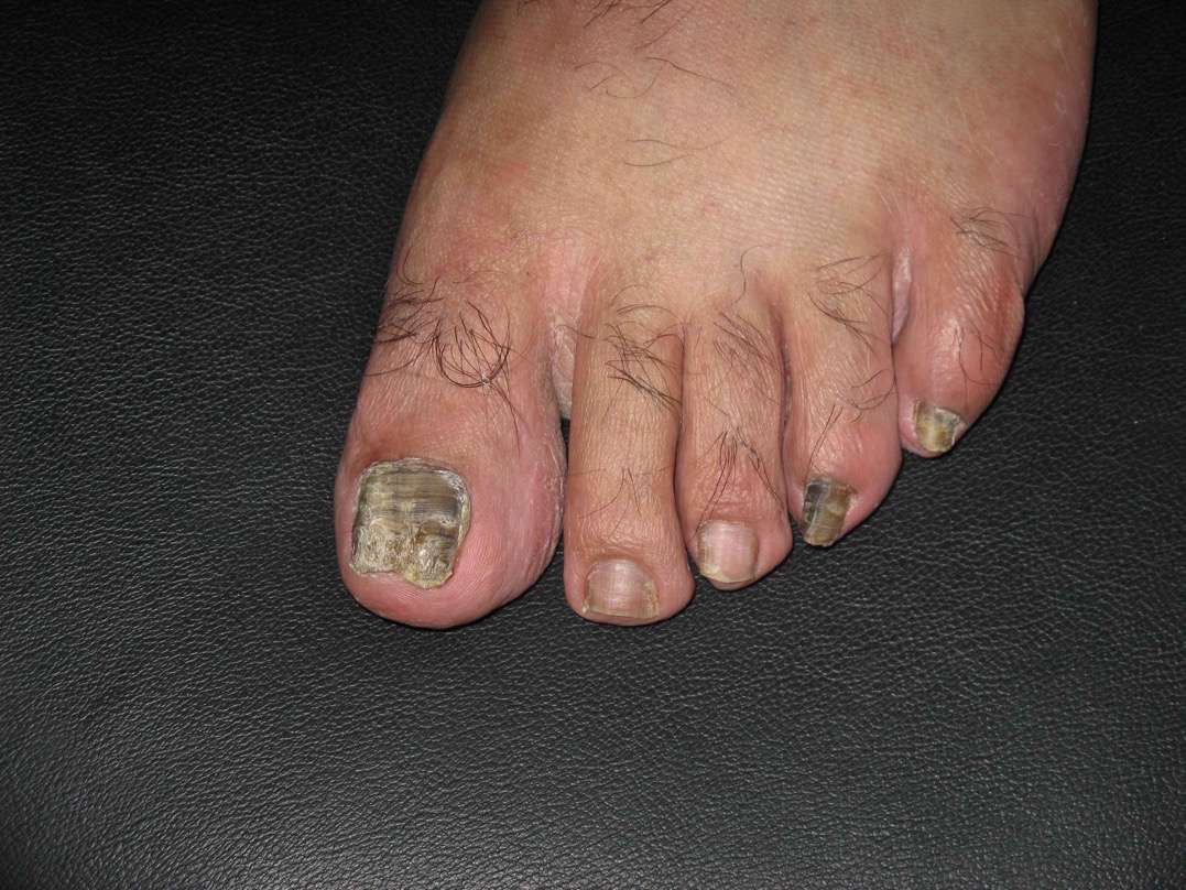 onychomycosis-dermacosm