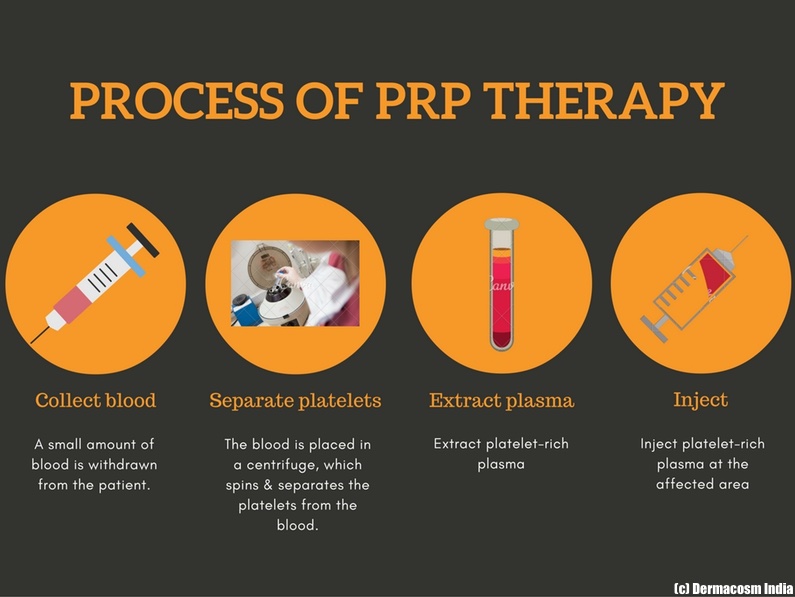 PRP for hair loss & baldness: does it work? - dermacosm