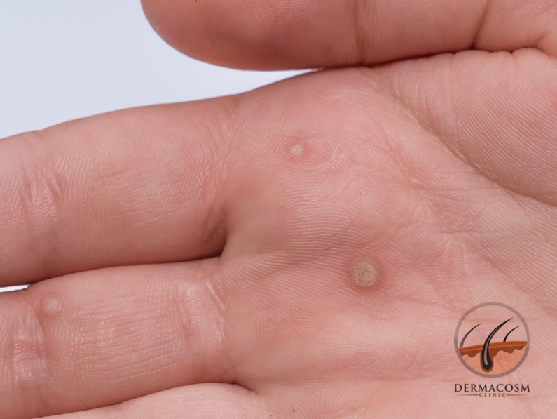 Warts - all you need to know